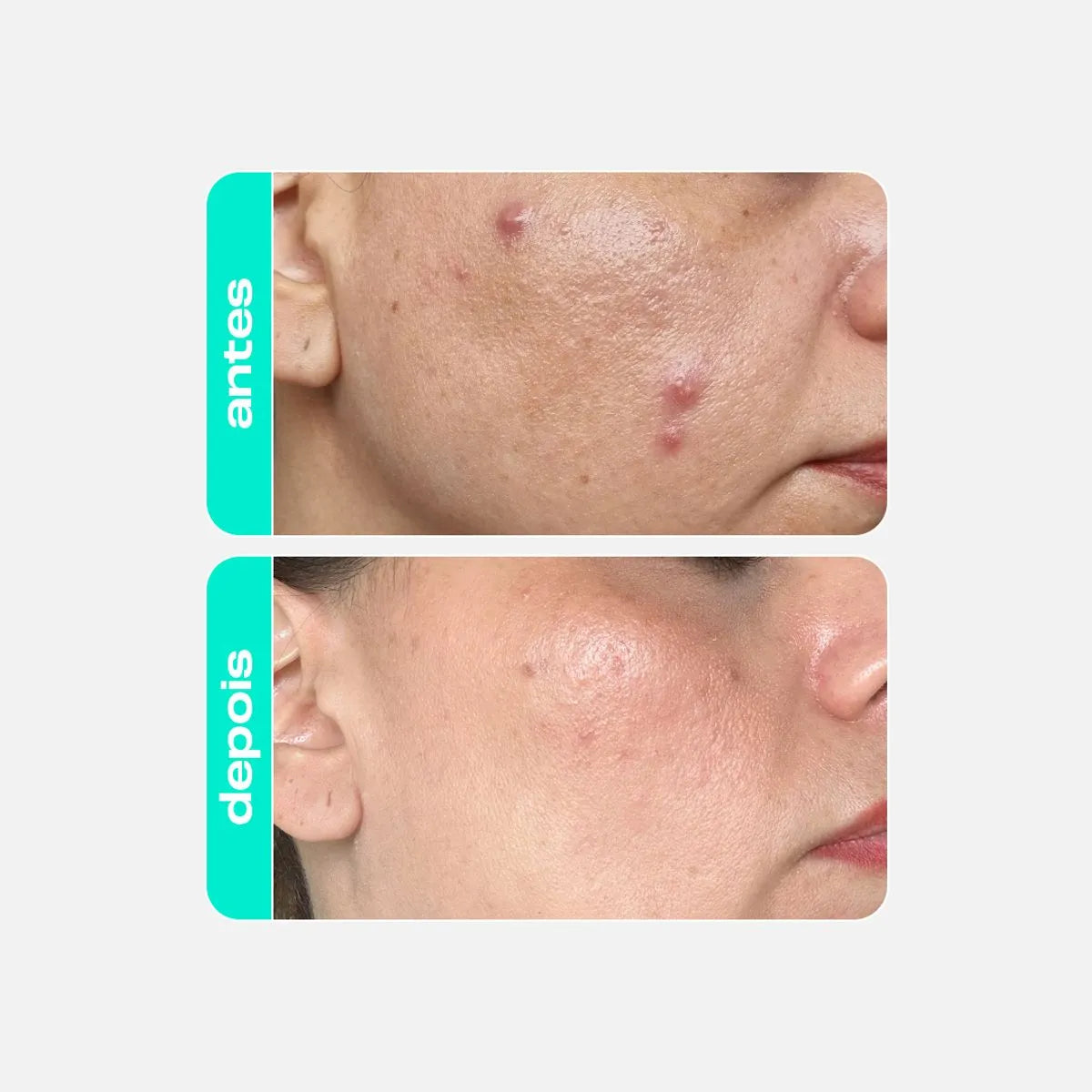 Tônico Antioleosidade Creamy - Ácido Salicílico