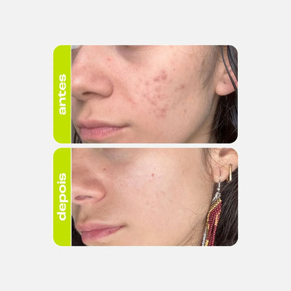 Tônico Clareador - Ácido Tranexâmico Creamy